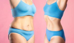 The Science Behind Liposuction and Fat Removal Explained