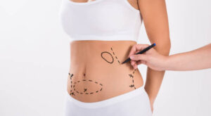 Liposuction’s Impact on Body Contouring and Self-Image