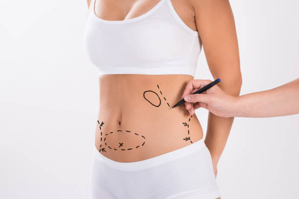 Liposuction’s Impact on Body Contouring and Self-Image