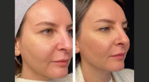 Mesotherapy in Dubai – Benefits for Smooth, Glowing Skin