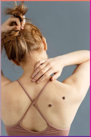 Mole Removal in Dubai: How Dermatologists Ensure Safe Procedures