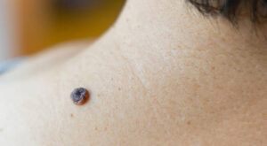 Mole Removal in Dubai: Boost Confidence, Smooth Skin Fast