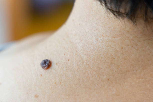 Mole Removal in Dubai: Boost Confidence, Smooth Skin Fast