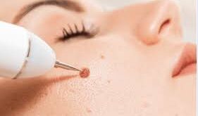 Mole Removal in Dubai: Expert Dermatologists Near You