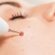 Mole Removal in Dubai: Expert Dermatologists Near You