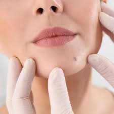 Mole Removal in Dubai: Quick, Painless Procedures Revealed