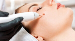 How to Get Mole Removal in Dubai Safely