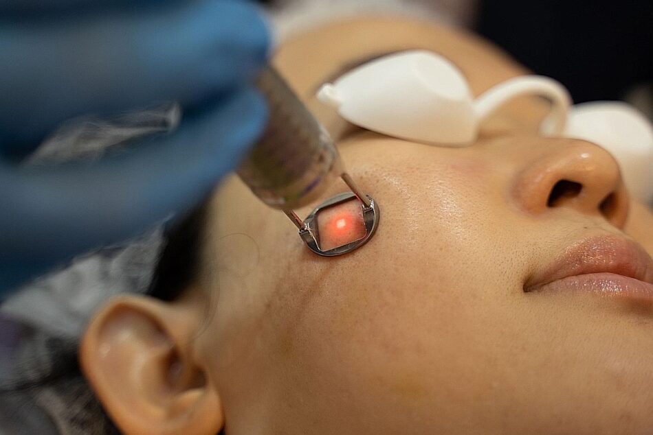 Transform Dull Skin Into Vibrant Glow Quickly With Picosure Laser Treatment