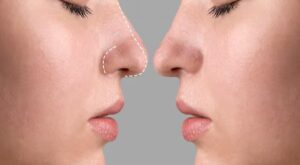 Rhinoplasty in Dubai: Top Trends Transforming Nose Aesthetics