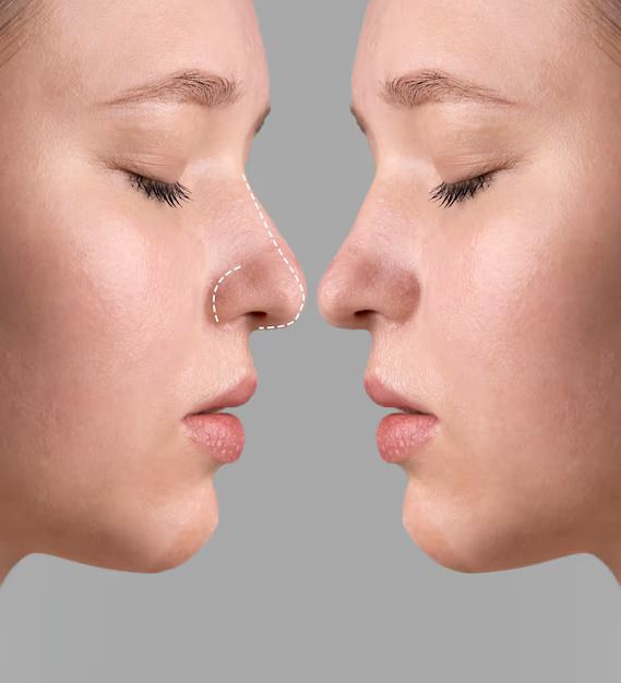 Rhinoplasty in Dubai: Top Trends Transforming Nose Aesthetics