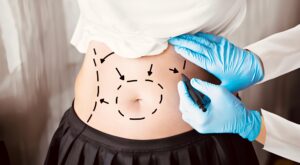 Tummy Tuck in Dubai: Methods to Boost Body Elegance and Shape