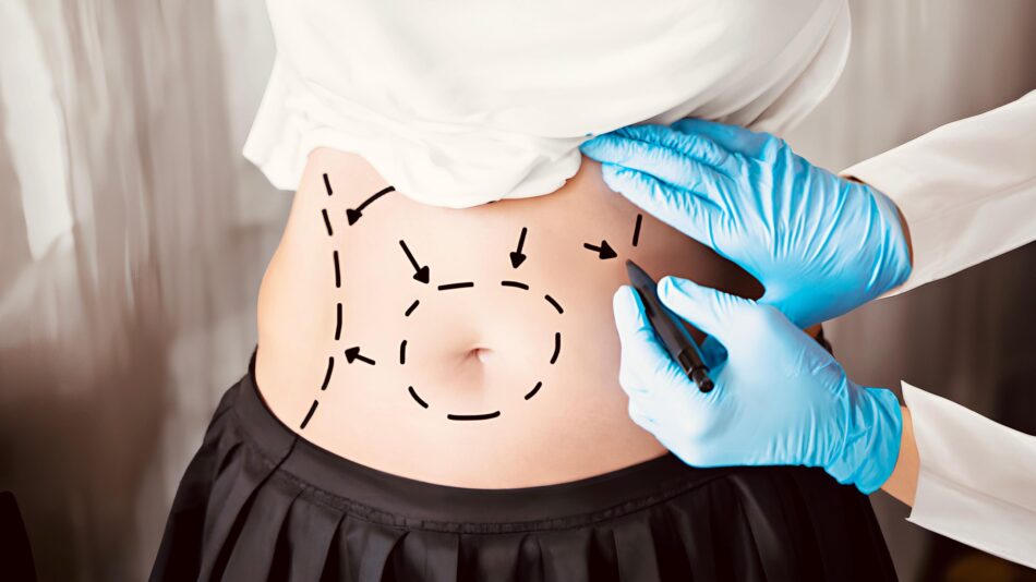 Tummy Tuck in Dubai: Methods to Boost Body Elegance and Shape