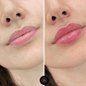 Juvederm Lip Projection Techniques by the Best Plastic Surgeon in dubai