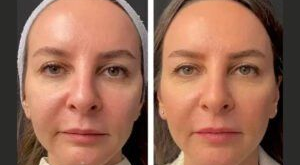 Mesotherapy in Dubai: Your Path to Refreshed, Youthful Skin