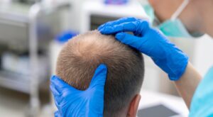 Fast Hair Transplant Solutions That Restore Your Hairline Safely