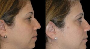 Why Expats Choose Best Doctors in Dubai for Double Chin Removal
