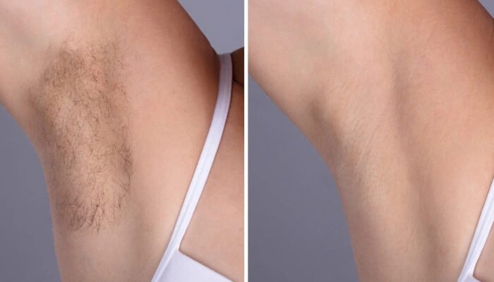Best Plastic Surgeon in Dubai: Pro Tips to Prepare for Laser Hair Removal