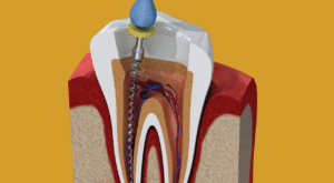What Improves Recovery After Root Canal in Dubai?