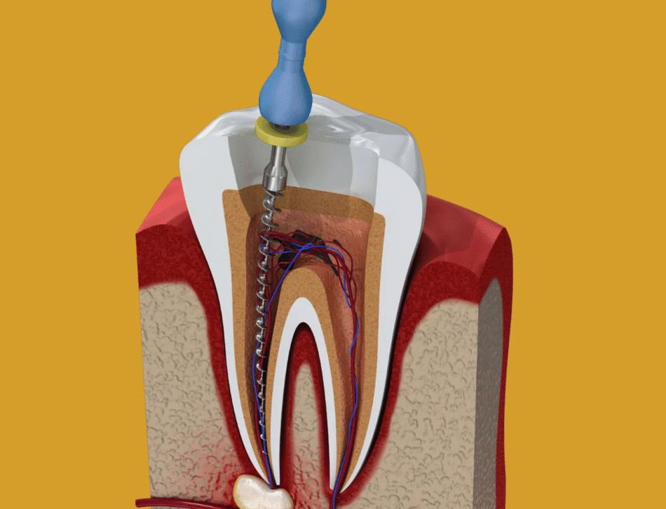What Improves Recovery After Root Canal in Dubai?