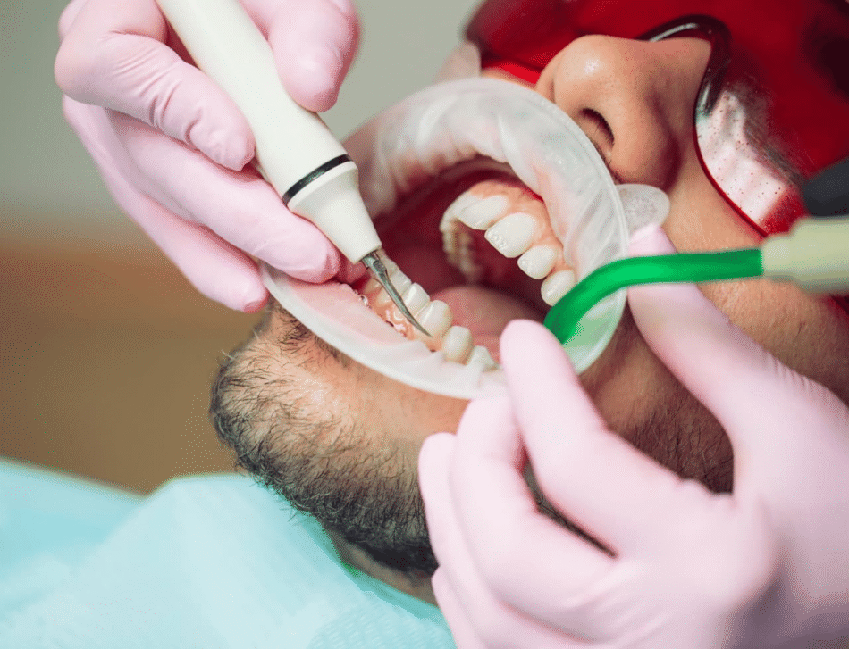 Who Needs Teeth Cleaning Cost Info for Planning?