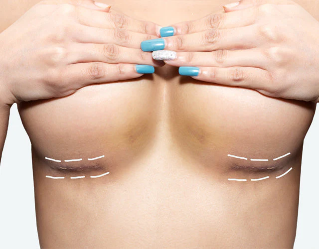 Breast Lift Dubai
