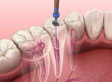 How to Treat a Sore Root Canal Tooth
