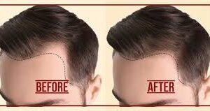 How to Choose the Best Hair Transplant Clinic in Inglewood: Expert Tips & Techniques