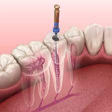 How to Treat a Sore Root Canal Tooth