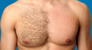 What Makes Patients Prefer Body Hair Transplant in Dubai Now?