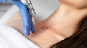 Tattoo Removal in Dubai: Achieve Flawless Skin Effortlessly