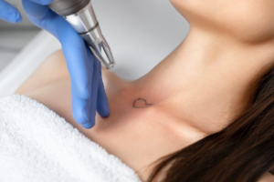 Tattoo Removal in Dubai: Achieve Flawless Skin Effortlessly