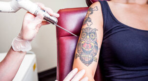 Picosure Tattoo Removal for Fast and Safe Ink Fade Results