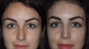 Rhinoplasty in Dubai for Wide or Bulbous Nose Correction