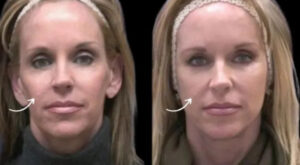 How the Best Plastic Surgeon in Dubai Uses Sculptra Fillers to Restore Youthful Facial Contours
