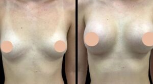 Best Breast Augmentation Surgeons in Dubai: Customized Treatment Plans for Every Body Type
