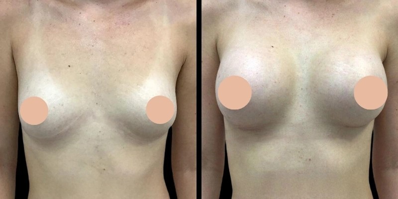 Best Breast Augmentation Surgeons in Dubai: Customized Treatment Plans for Every Body Type