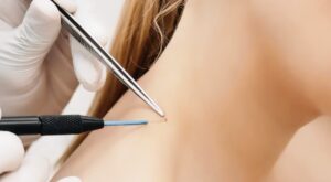 Can Skin Tag Removal in Dubai Be Performed Without Pain?