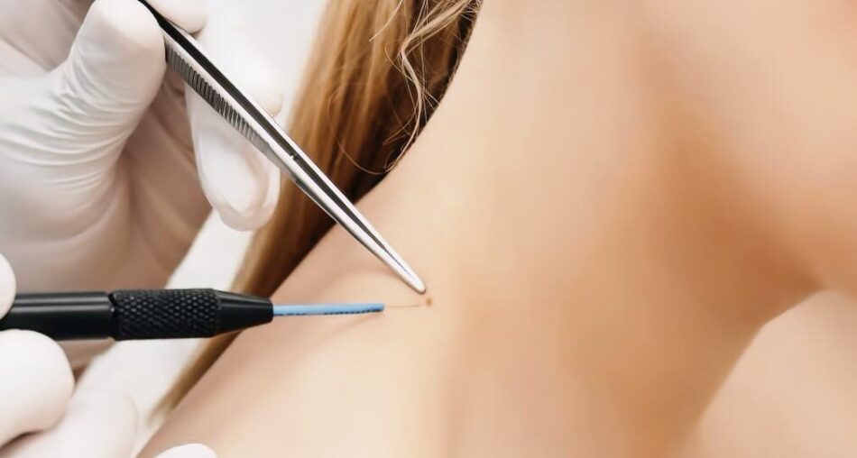Can Skin Tag Removal in Dubai Be Performed Without Pain?