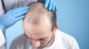 Hair Transplant for Crown Pattern Baldness