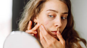 Microneedling Combined with Acne Treatment