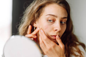 Microneedling Combined with Acne Treatment