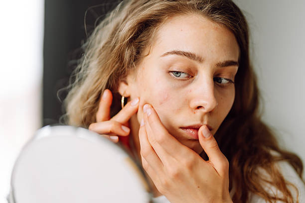 Microneedling Combined with Acne Treatment